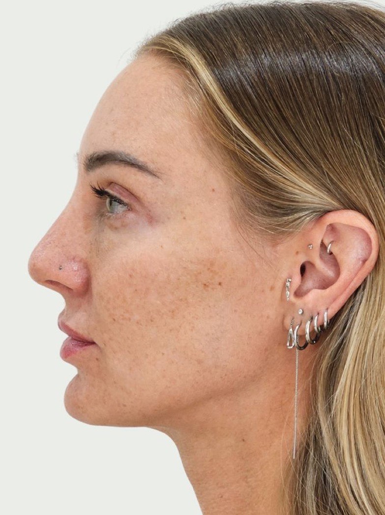 After dermal fillers