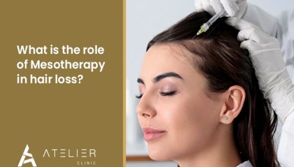 What is the role of Mesotherapy in hair loss?