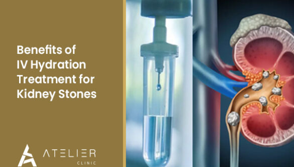 The Benefits of IV Hydration Treatment for Kidney Stones