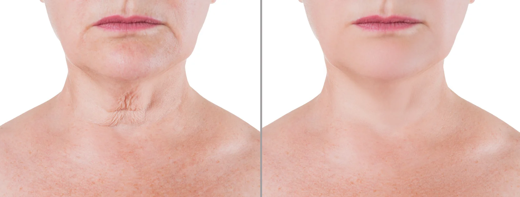 Face & Neck Lift 2