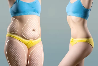 Liposuction