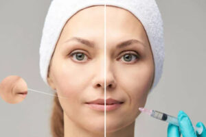 Say Goodbye to Your Acne in Less Time with Glutathione Injection